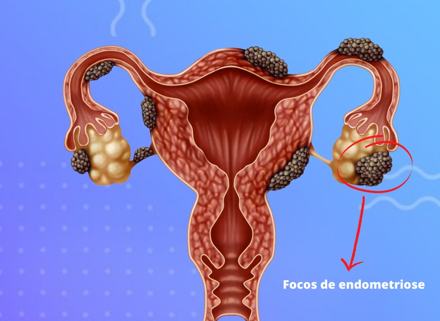 o-que-e-endometriose